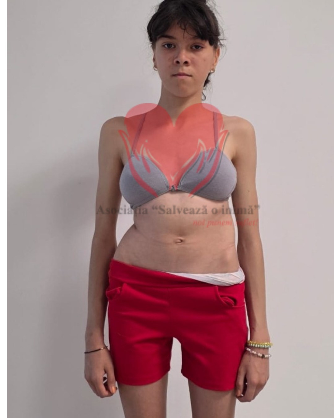 Andreea are nevoie de noi pentru a se opera: Este un început care ne dă speranță