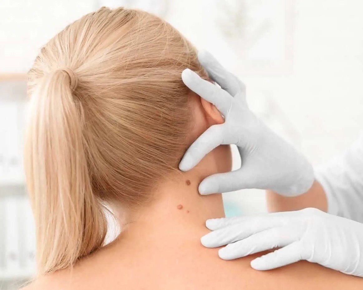 Nu neglijați alunițele! Medic de la „Mavromati”, despre primele semne la care trebuie să fim atenți – VIDEO 