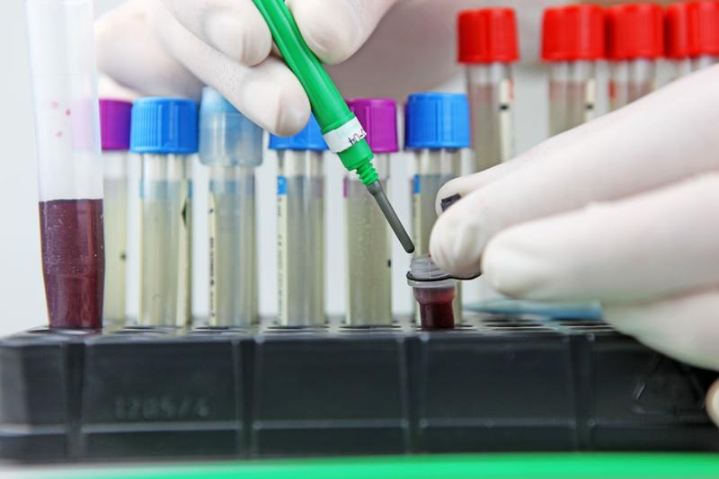 A fost identificată o tulpină de Candida auris rezistentă la patru clase de antifungice. Este al doilea caz documentat la nivel mondial