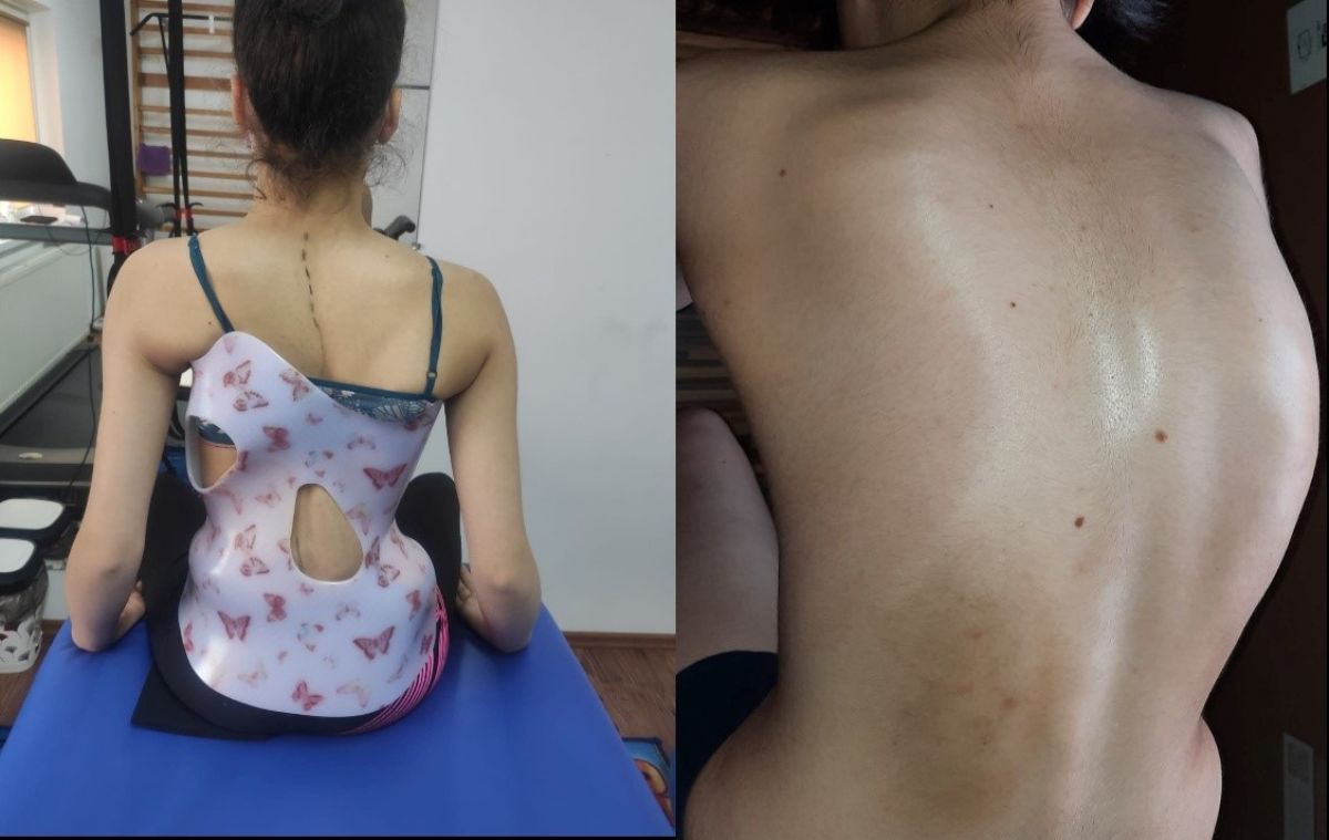 AVERTISMENTUL unui medic botoșănean - Ghiozdanul greu, telefonul și televizorul pot distruge coloana copiilor care rămân cu urmări pe viață