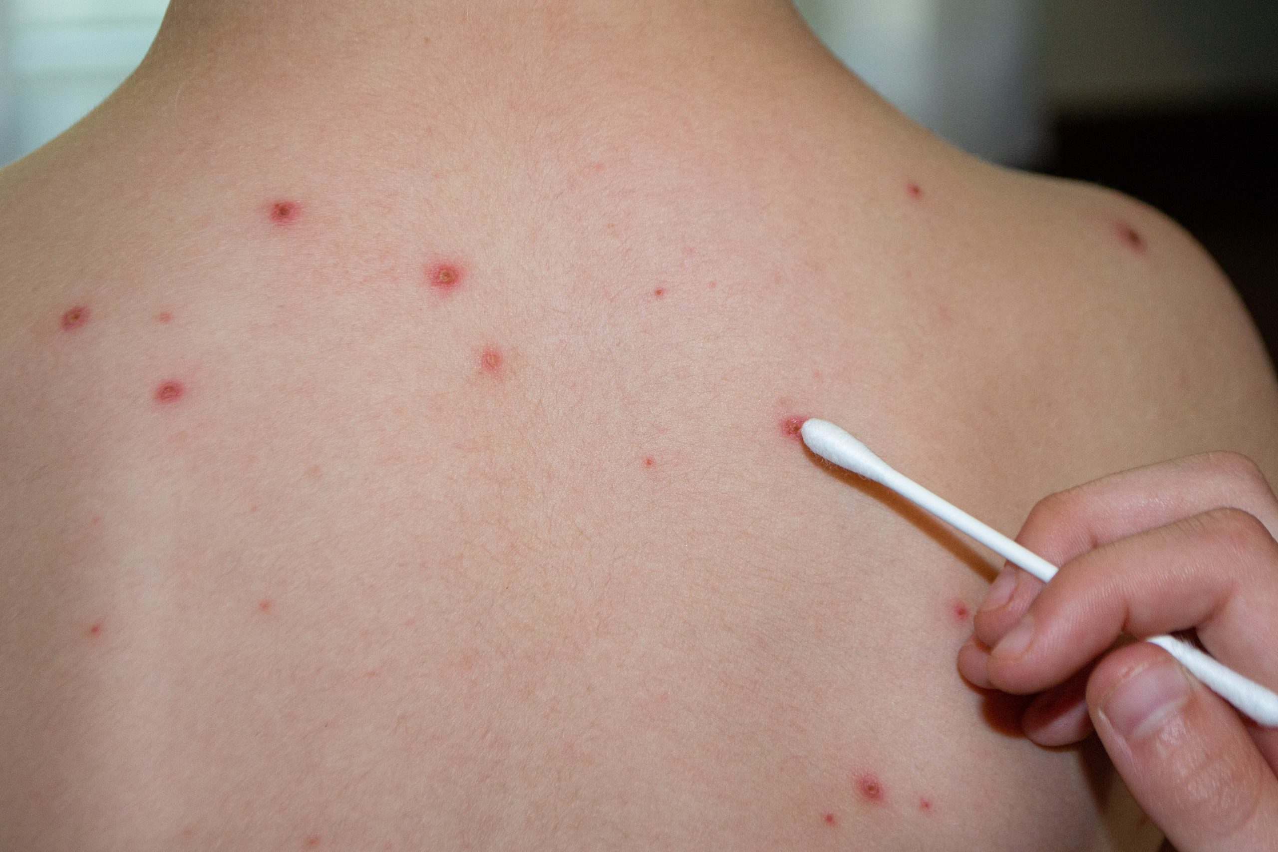 Rujeola revine puternic în România: Medicii avertizează că scăderea vaccinării îi expune pe cei mai vulnerabili
