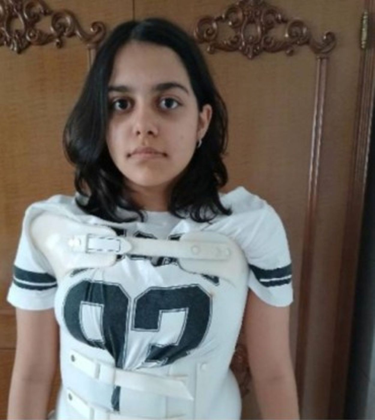 Sara, tanara cu scolioza severa.j